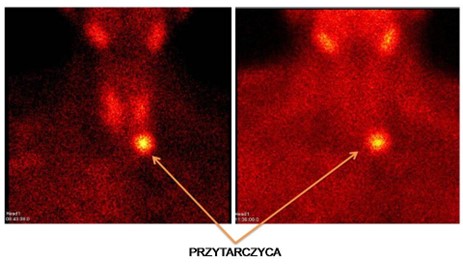 przytarczyca